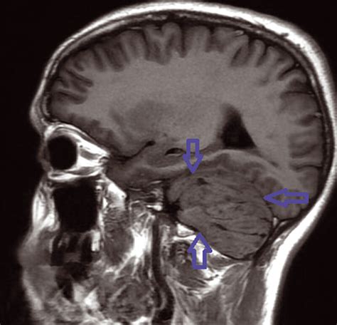 Left Mass Cerebellum In T1 Weighted Sequence Mri Download Scientific Diagram