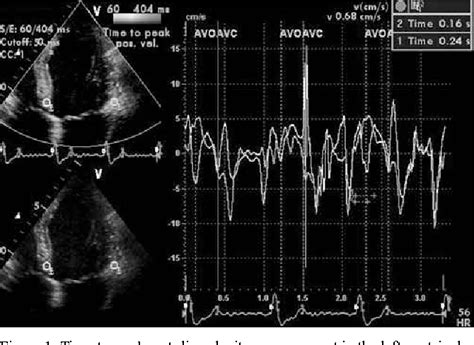 Figure 1 From Comparison Of Echocardiographic Markers Of Cardiac Dyssynchrony And Latest Left