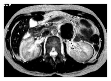 Abdominal Manifestations Of Lymphoma Spectrum Of Imaging Features