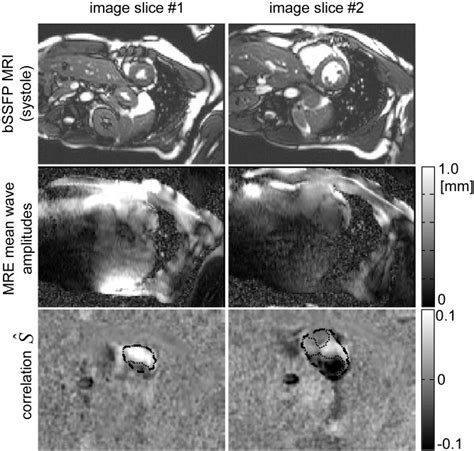 Mr Elastography Of The Human Heart Noninvasive Assessment Of