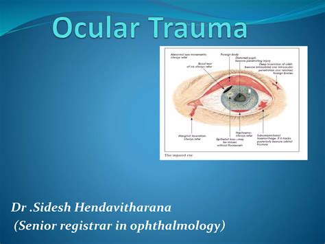 Ocular Trauma Ppt