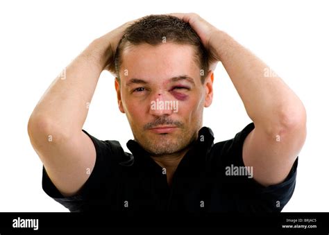 Man With Broken Crooked Nose And Black Crossed Eyes Isolated On