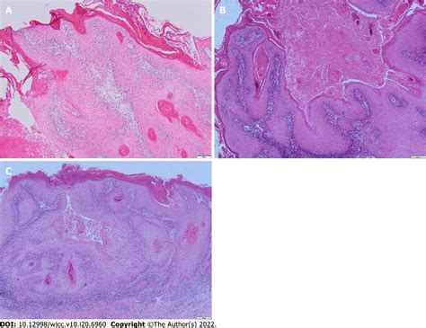 Figure 1 From Lower Lip Recurrent Keratoacanthoma A Case Report