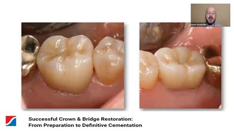 Successful Crown And Bridge Restoration From Preparation To Definitive Cementation Youtube