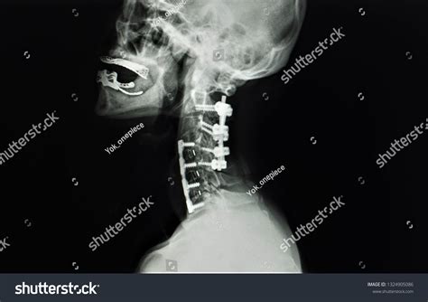 Lateral Plain Radiograph Of The Cervical Spine The Bmj Images