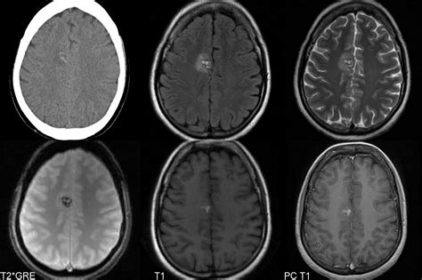 HEMANGIOMA SPINE MRI RADIOGRAPHICS - Wroc?awski Informator Internetowy - Wroc?aw, Wroclaw ...