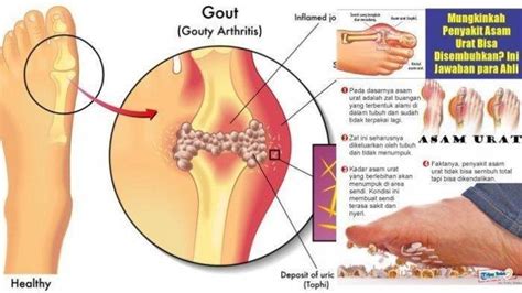 Normal Asam Urat Perempuan Berapa Cek Juga Ciri Ciri Asam Urat Kumat