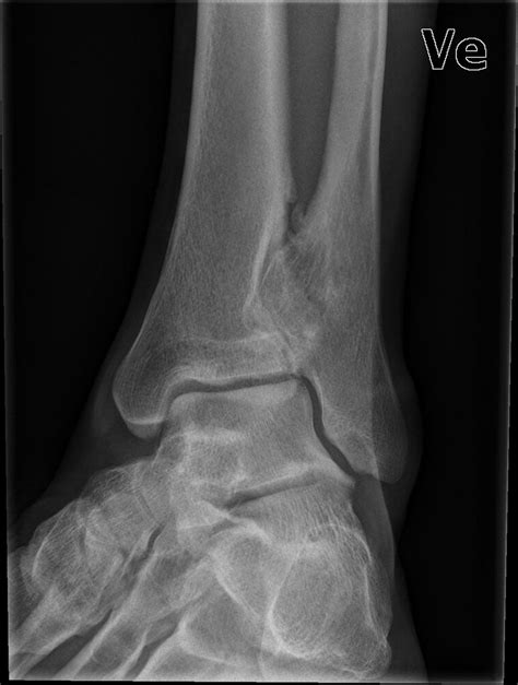 Arthrodesis Of The Distal Tibiofibular Joint For An Osteochondroma In