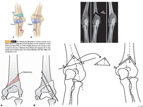 Supracondylar osteotomy for treatment of cubitus varus