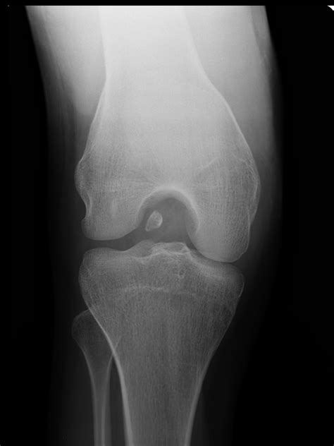 Intra Articular Loose Body Knee Image Radiopaedia Org