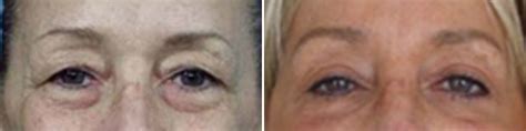 Blepharoplasty Recovery Timeline Dr Douglas Steinbrech