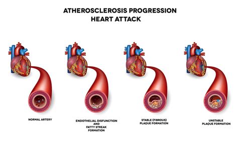 Come Riconoscere Un Infarto Miocardico Sintomi E Terapia