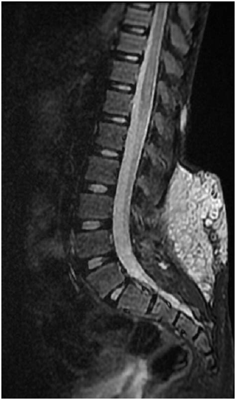 Strangled By His NervesCervical Plexiform Neurofibroma With Infantile