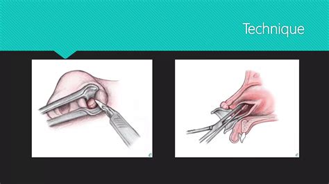 Nasal Septal Hematoma Drainage Ppt