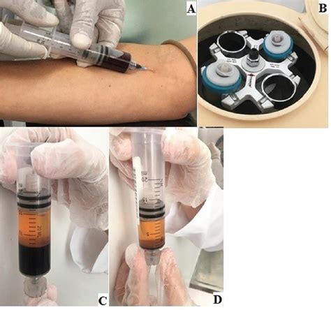 SciELO Brasil Development Of A Device To Obtain Platelet Rich