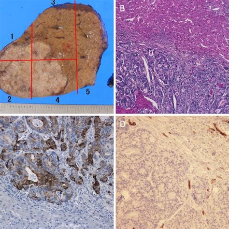 Macroscopic And Histological Findings Of The Resected Specimen With