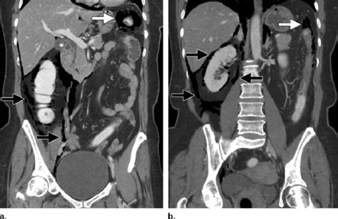 Necrotizing Retroperitoneal Fasciitis Mimicry In A 65 Year Old Woman Download Scientific