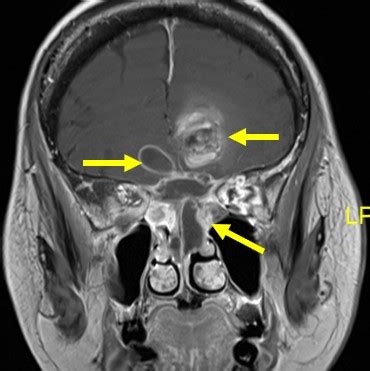 Acute Invasive Fungal Sinusitis Radiology Cases