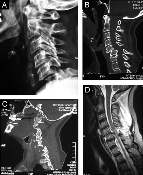 Figure From Anterior Subluxation Of The Cervical Spine 47 Off