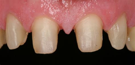 Crown Information Sheet — EVANS PROSTHODONTICS