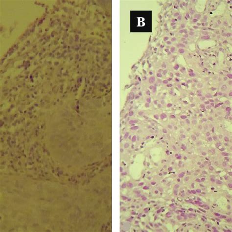 Histological Grade Differentiation Of Squamous Cell Carcinoma Scc In