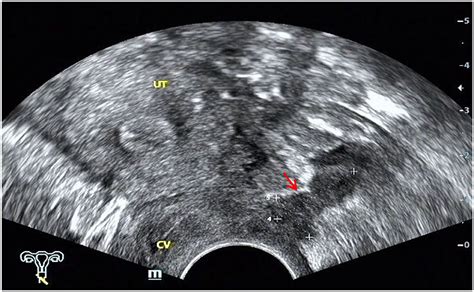 Frontiers Diagnosis Of Deep Infiltrating Endometriosis Using