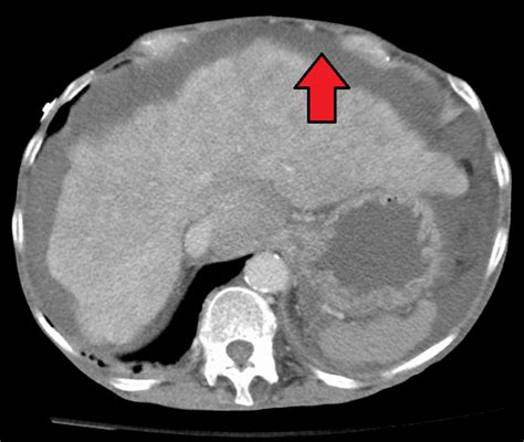 End Stage Liver Disease Esld Pathogenesis And Liver Transplantation