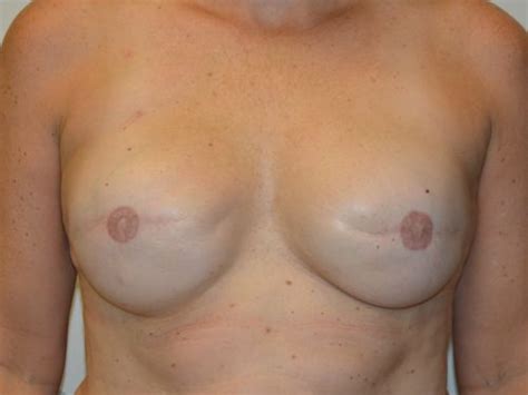 Breast Reconstruction Tissue Expanders 24 Before After Gallery