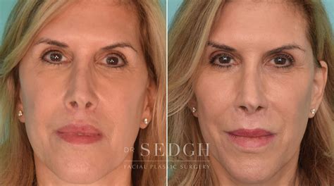 Facial Fillers Before And After Photos Dr Sedgh