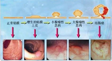 结直肠息肉，会癌变吗？ 春雨医生