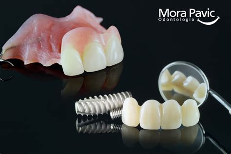 Implante dental vs Prótesis removible Cuál es la mejor opción