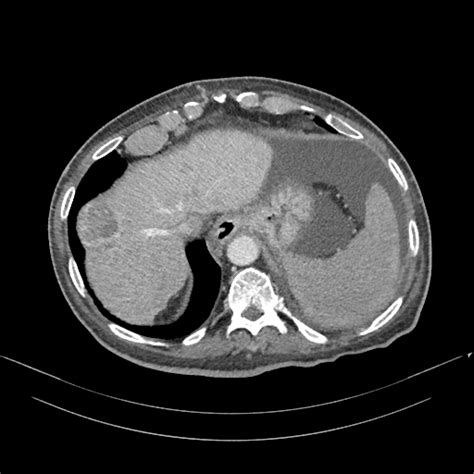 Multicenteric Hepatocellular Carcinoma In A Cirrhotic Liver Image