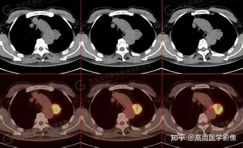 PET CT病例肺鳞癌5例高尚医学影像 知乎