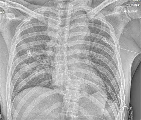 Anterior Posterior Chest X Ray Taken On Initial Presentation Showing