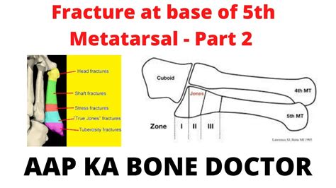 Fracture At The Base Of 5th Metatarsal Part 2 Episode 2 Youtube