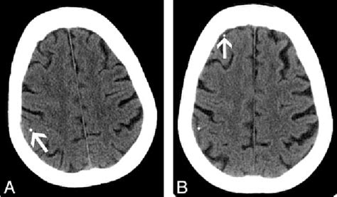 [pdf] Calcified Cerebral Emboli Semantic Scholar