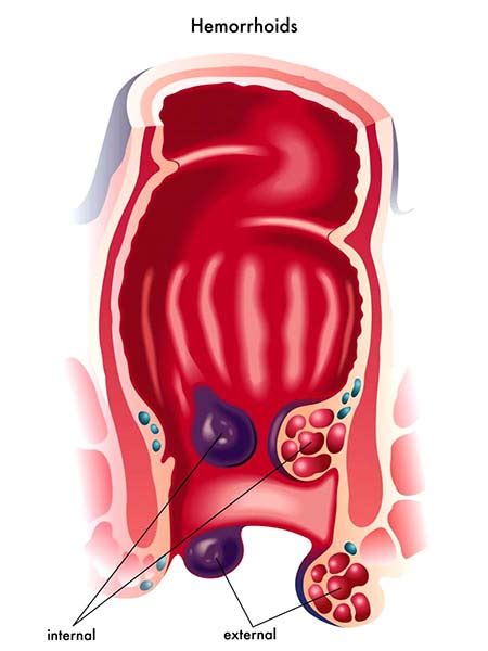 Piles (Hemorrhoids) - WelcomeCure