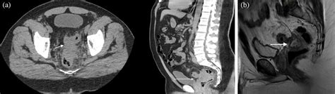 (a) CT images illustrating phlegmonous 'rectal mass' and colorectal ...