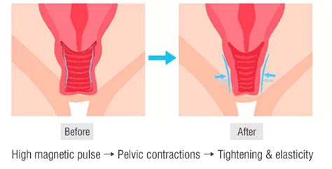 Non Invasive Electromagnetic Stimulation Comfortably Pelvic Floor