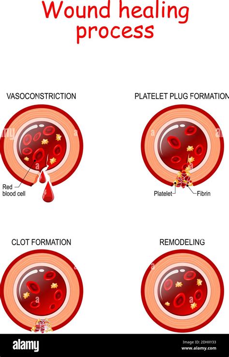 Phases of the wound healing process. Hemostasis, Inflammatory, Proliferative, Maturation and ...