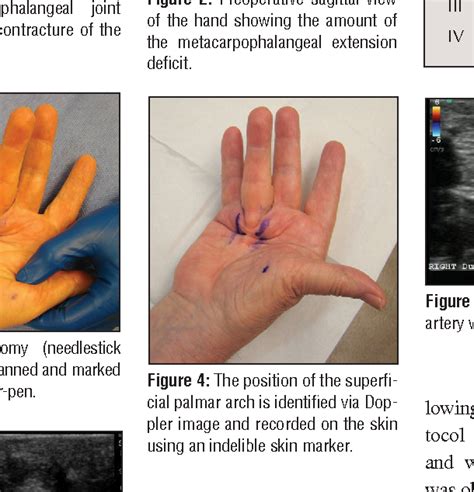 Figure 3 From Ultrasound Assisted Percutaneous Needle Fasciotomy For