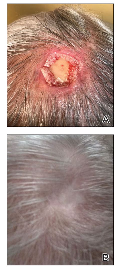 Extracellular Matrixbased Collagen Dressings For Scalp Repair