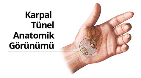 Karpal Tünel Sendromu Karpal tünel nedir Karpal tünel nasıl tedavi