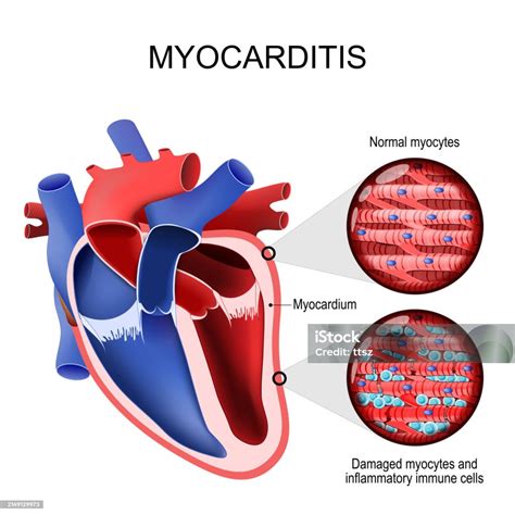 Ilustración De Miocarditis Miocardiopatía Inflamatoria Sección