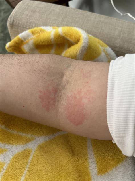 New Rash On Elbow R Lupus