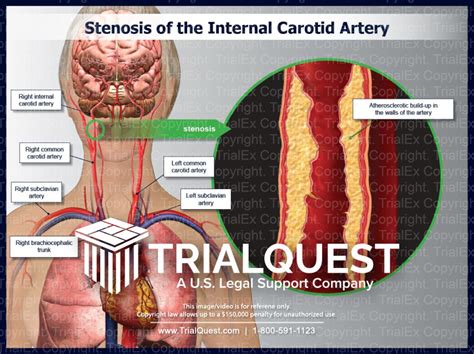 Internal Carotid Artery Stenosis