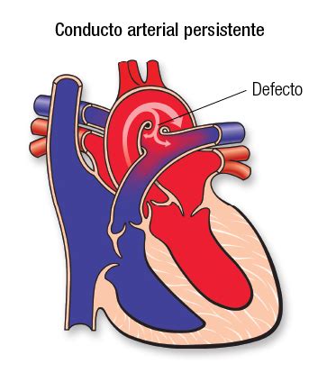 Persistencia Del Ductus Arterioso PDA American Stroke Association