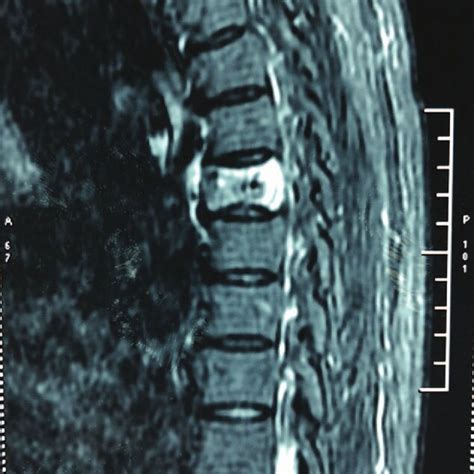 Pre Operative Thoracic Spinal Mri Shows Compression Fractures Of T