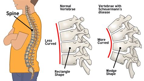 Scheuermann’s Disease