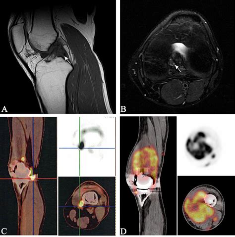 Frontiers Case Report Pulmonary Metastases From Epithelioid Sarcoma